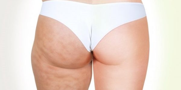 L’appareil anti-cellulite : une solution efficace pour lutter contre la peau d’orange et les capitons ?